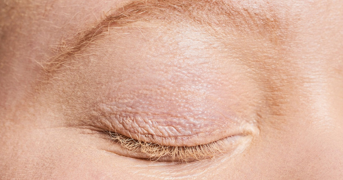 A close-up of a closed eyelid with dry, finely creased skin