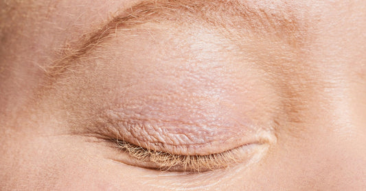 can-you-use-vaseline-on-your-eyelids-if-you-have-blepharitis