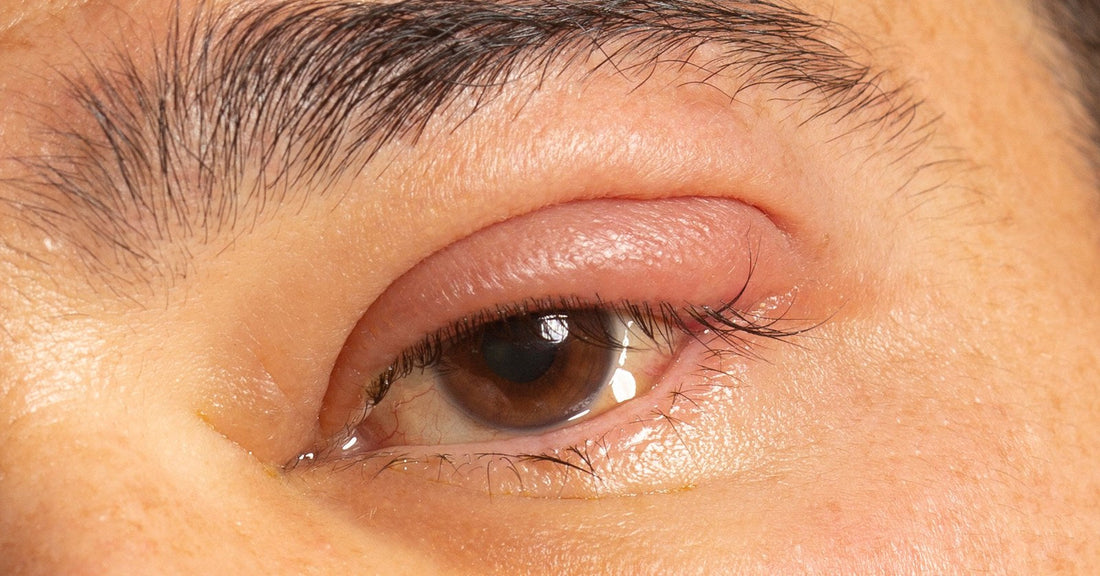 A close-up of a swollen, reddened upper eyelid with the eye still open