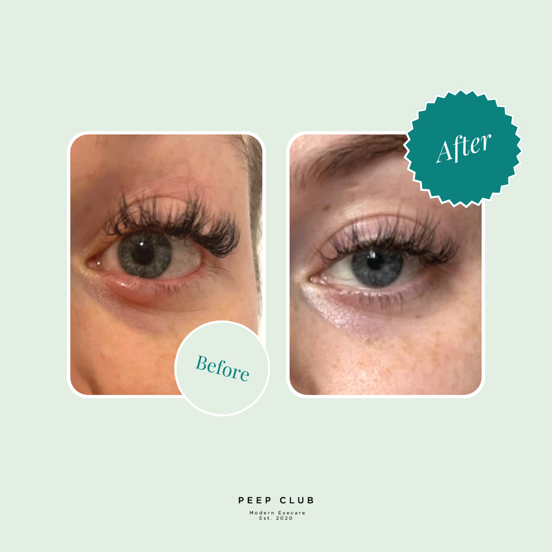 Stye Care Bundle--4